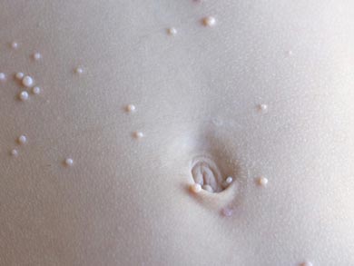 контагиозный моллюск у ребенка на животе