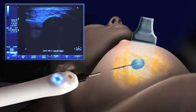 процесс проведения биопсии груди под контролем узи